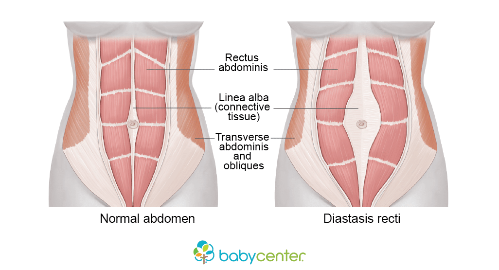 Peace Out Mummy Tummy-What is Diastasis Recti?